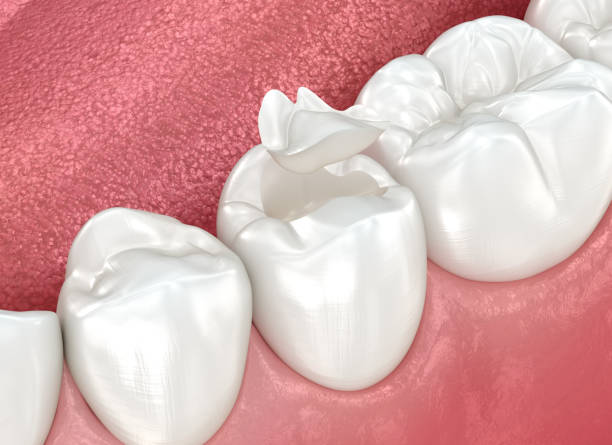 Dental Inlays and Onlays in Bonita, CA